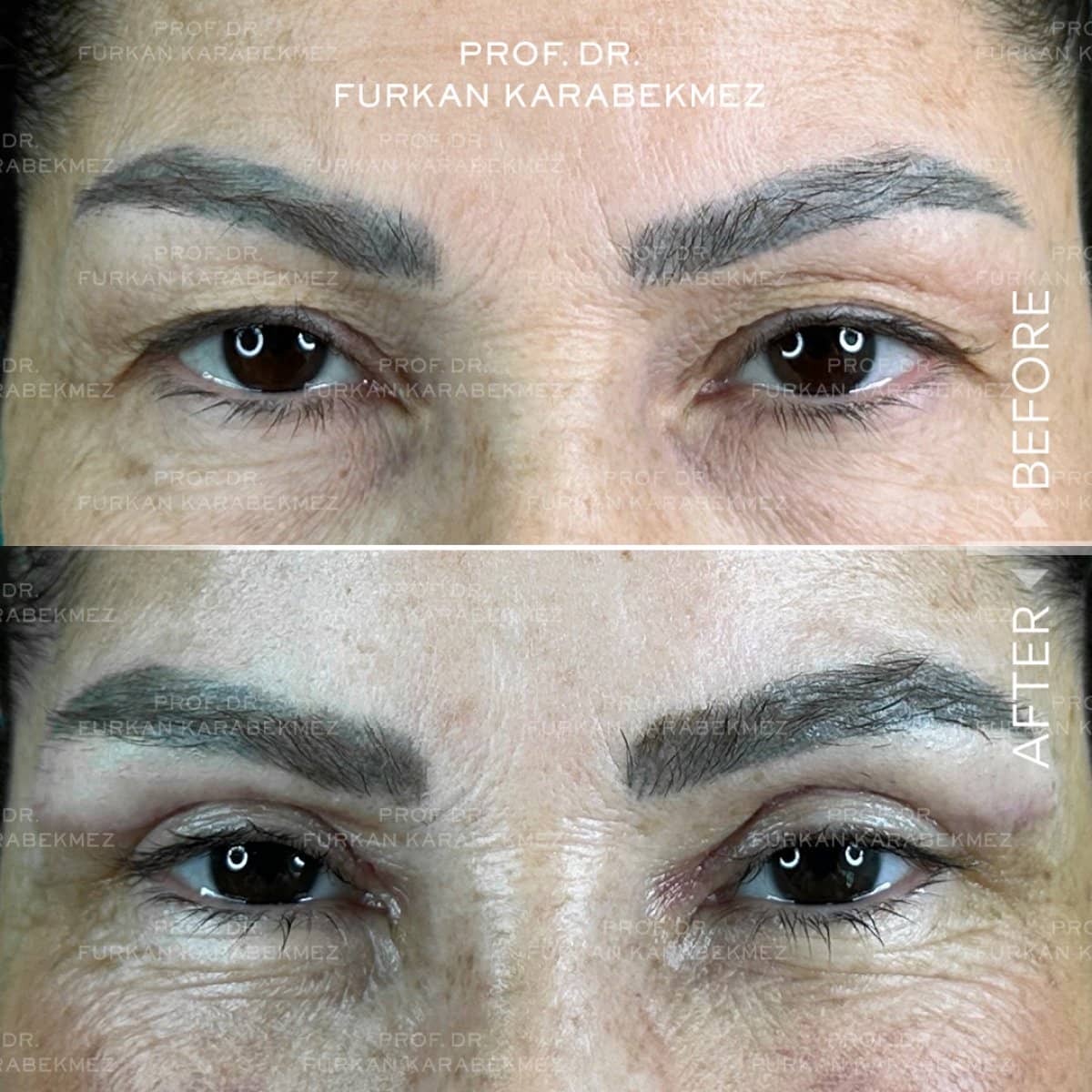 Case 16172 - blepharoplasty