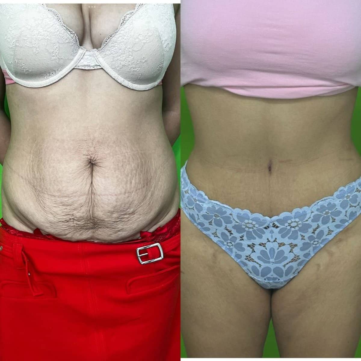 Case 16174 - liposuction