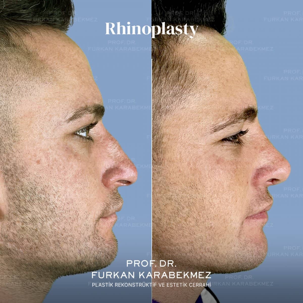 Case 16175 - rhinoplasty