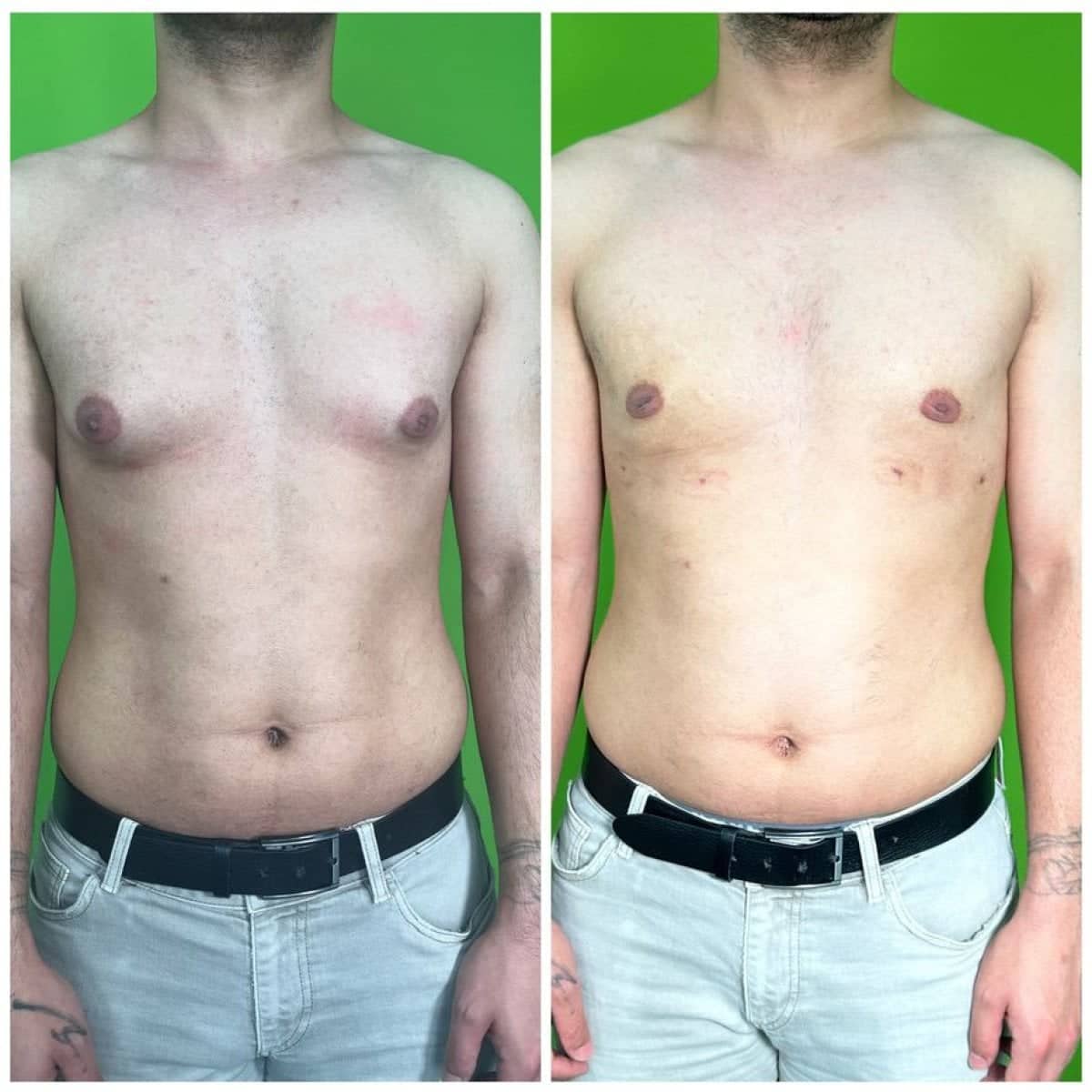 Case 16176 - gynecomastia surgery