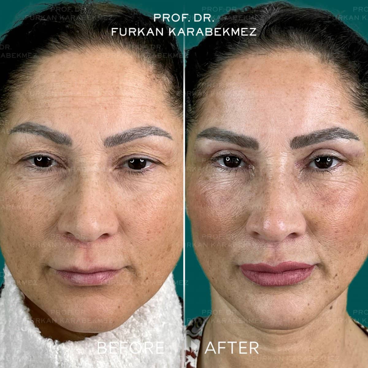 Case 16177 - blepharoplasty