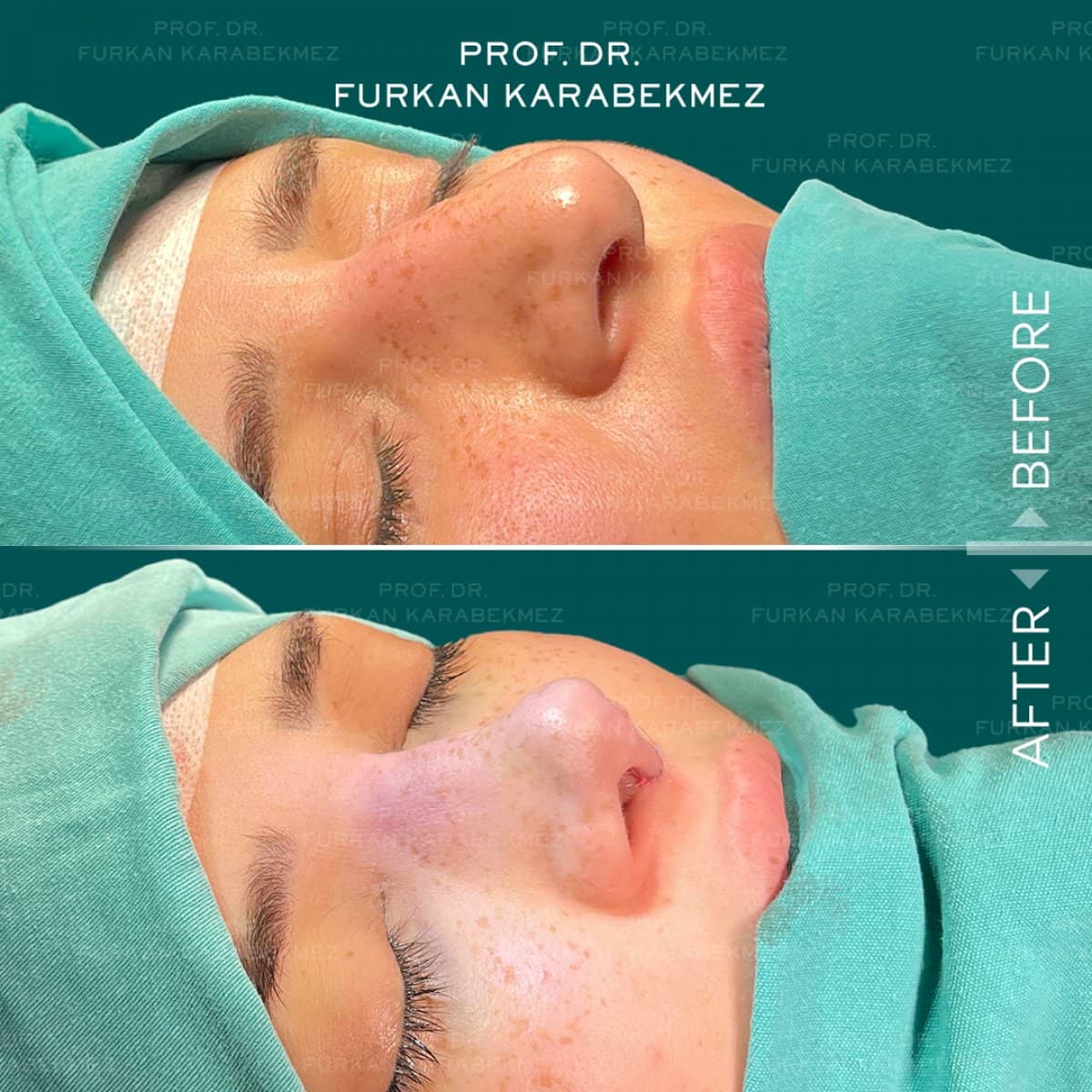 Case 16178 - rhinoplasty