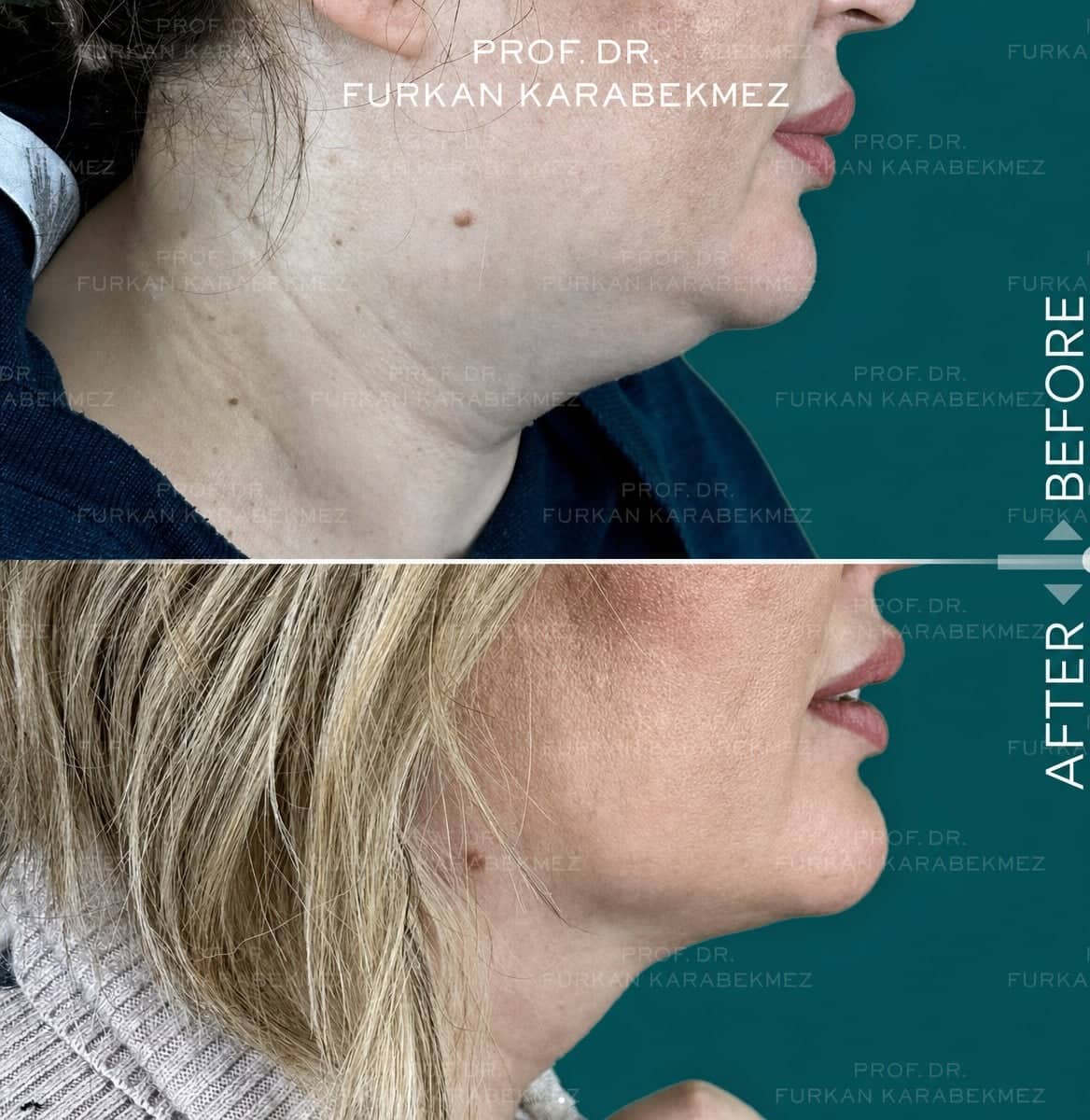 Case 16179 - chin liposuction
