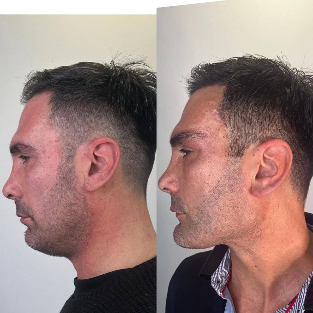 Case 16180 - chin liposuction