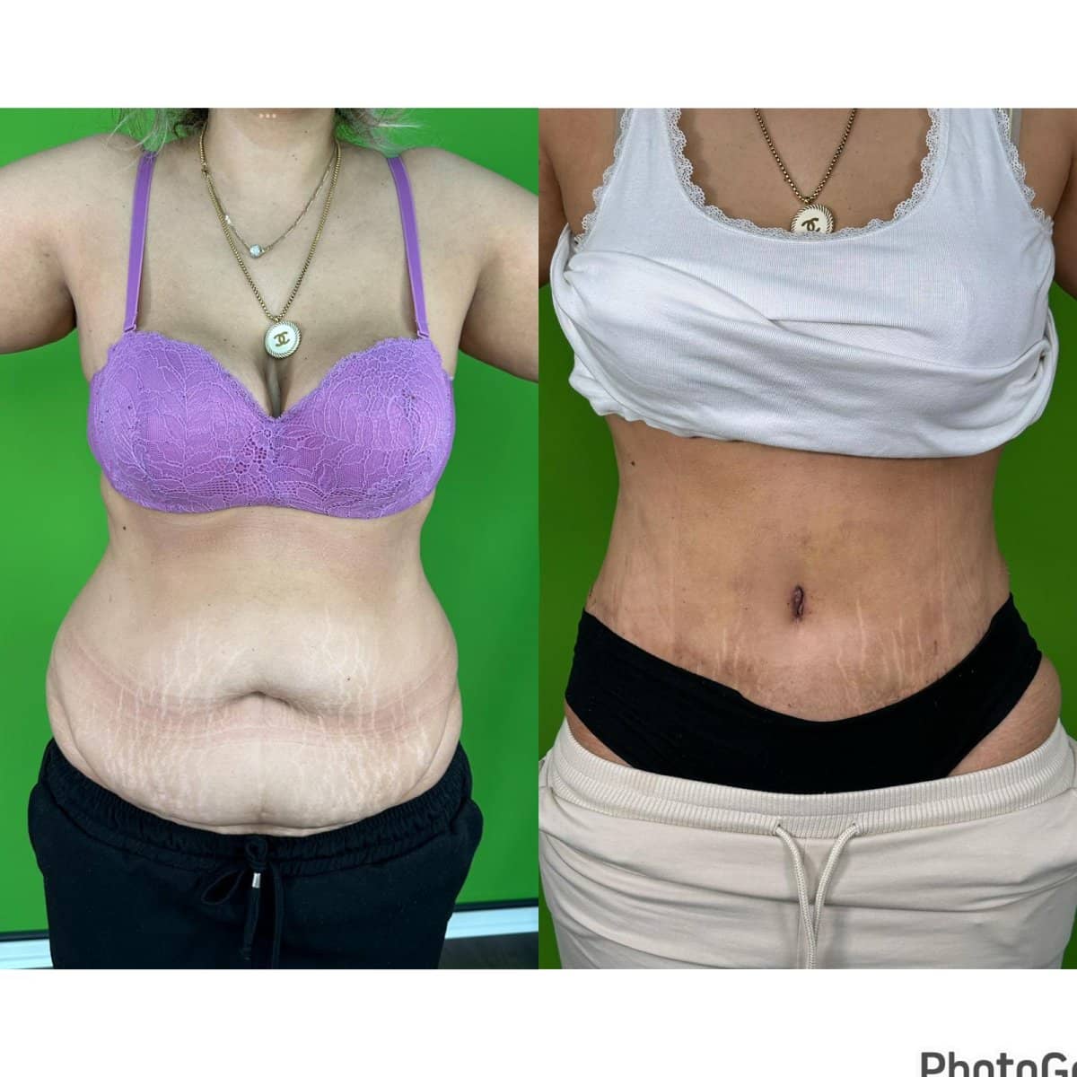 Case 16181 - liposculpture