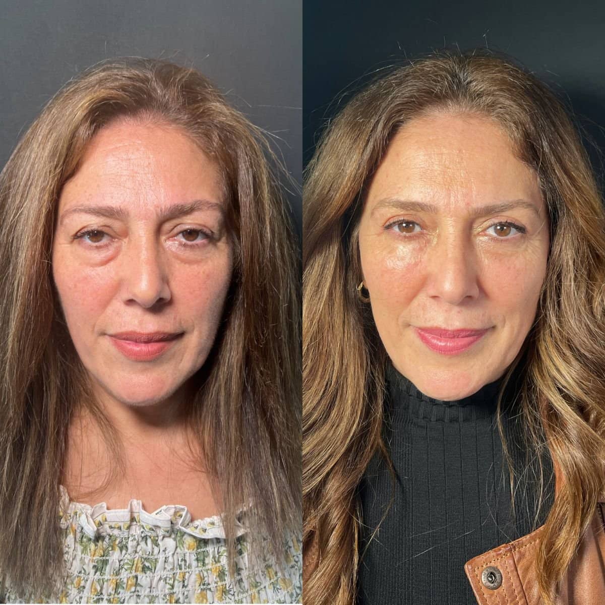 Case 16183 - facial fat transfer