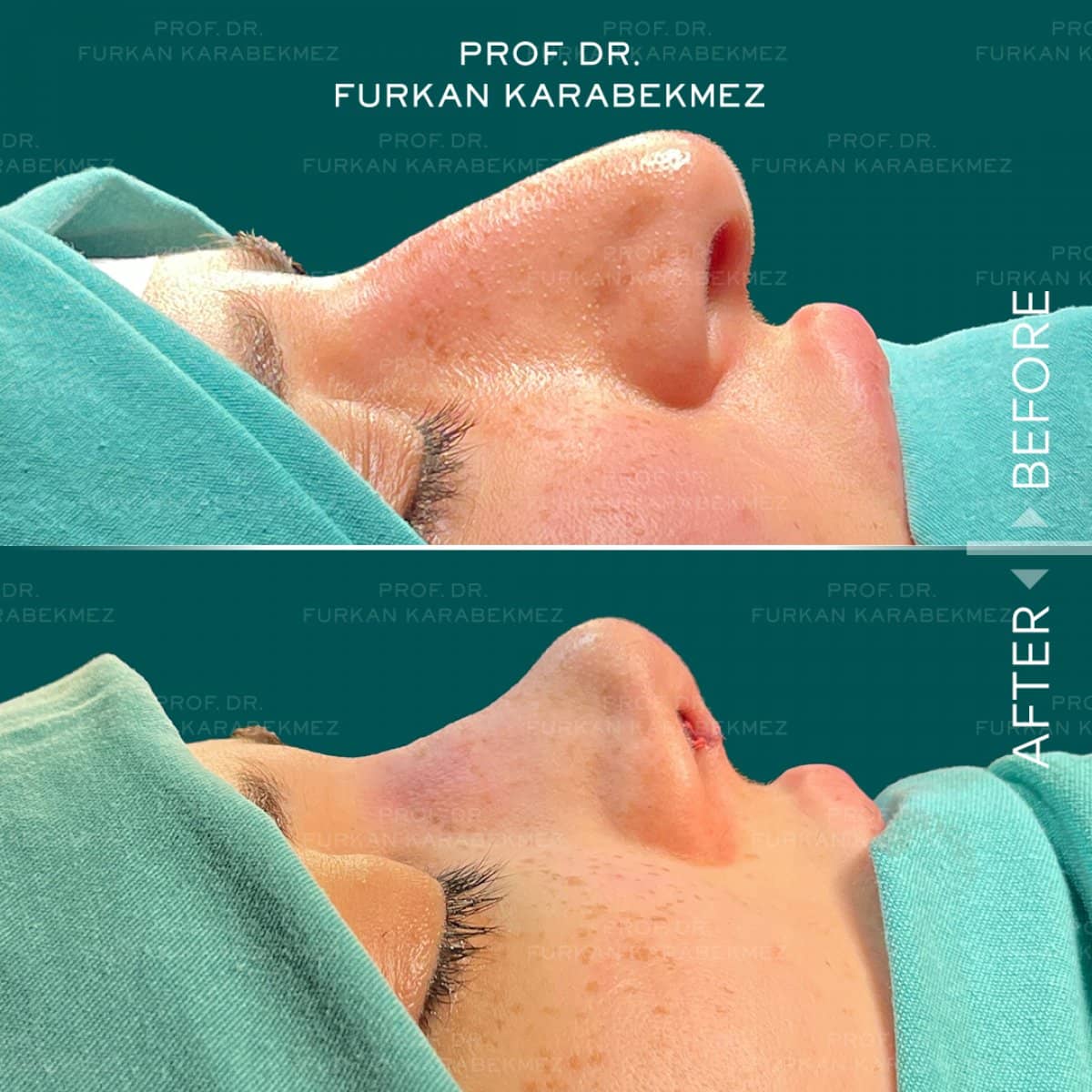 Case 16185 - rhinoplasty