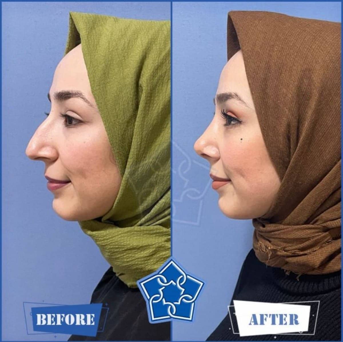 Case 16194 - rhinoplasty