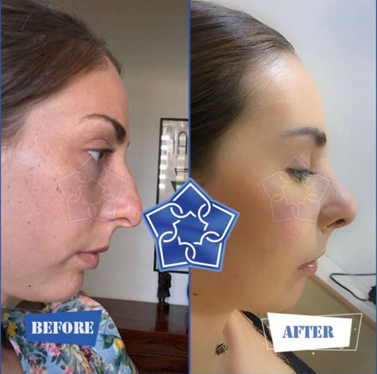 Case 16197 - rhinoplasty