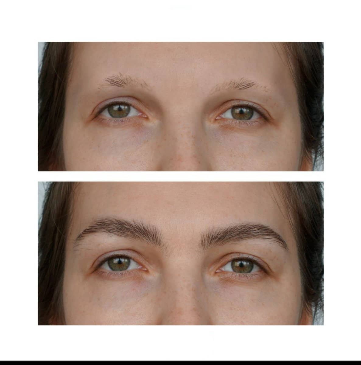 Case 16198 - eyebrow transplantation