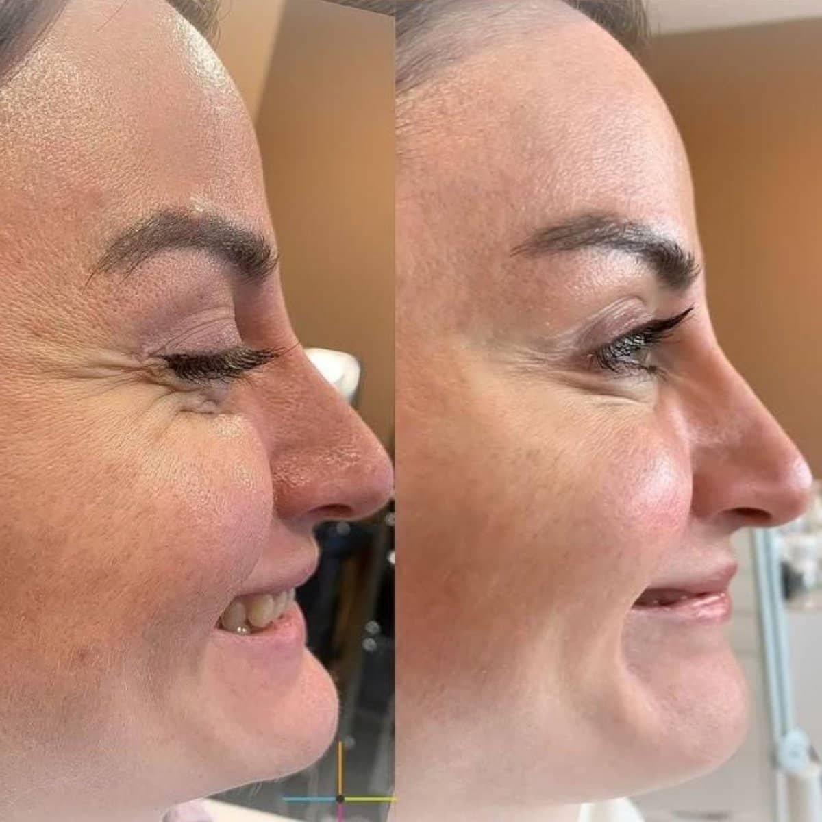 Case 16201 - Morpheus8 skin tightening