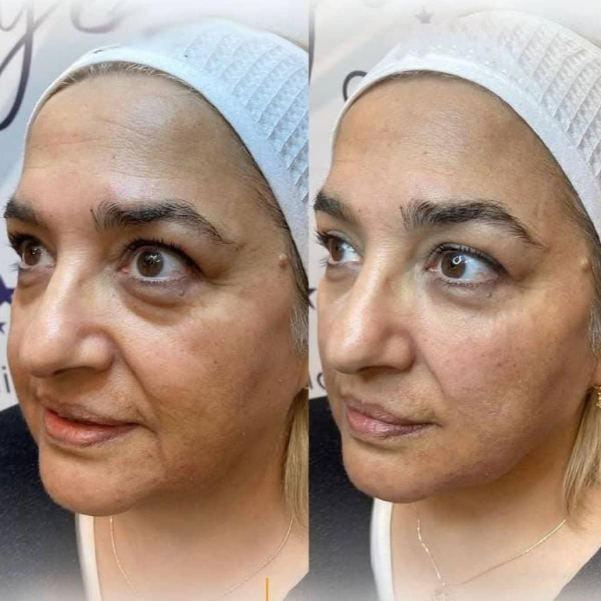 Case 16217 - Morpheus8 skin tightening