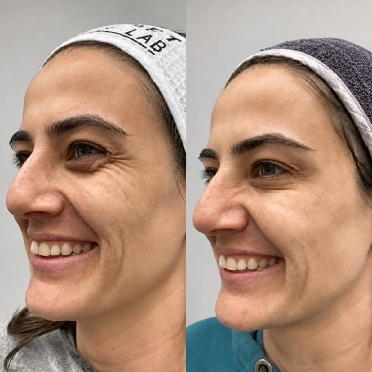 Case 16224 - Morpheus8 skin tightening