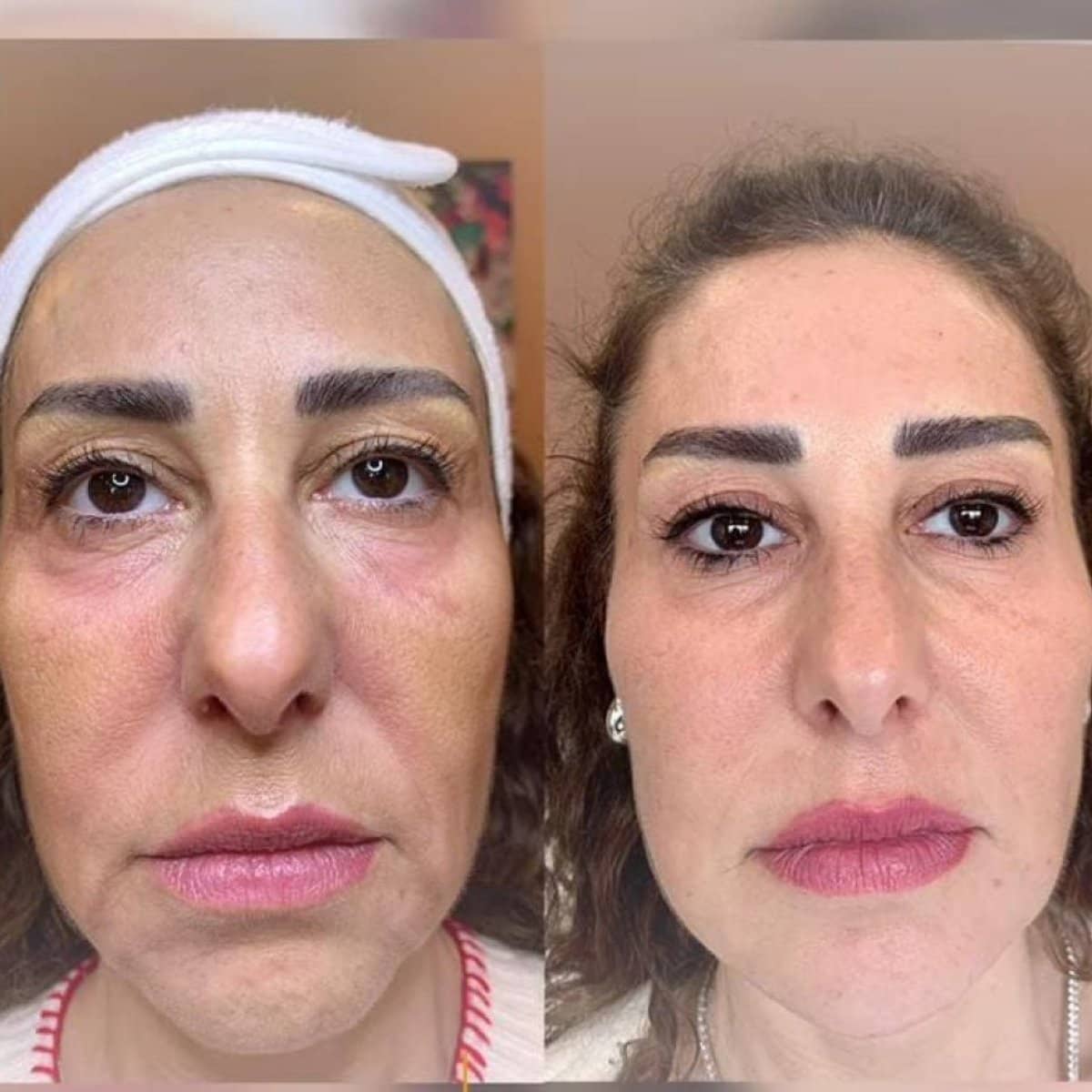 Case 16225 - Morpheus8 skin tightening