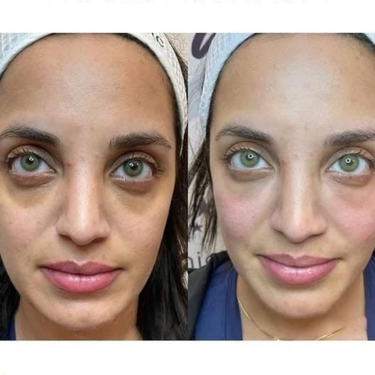 Case 16226 - Morpheus8 skin tightening