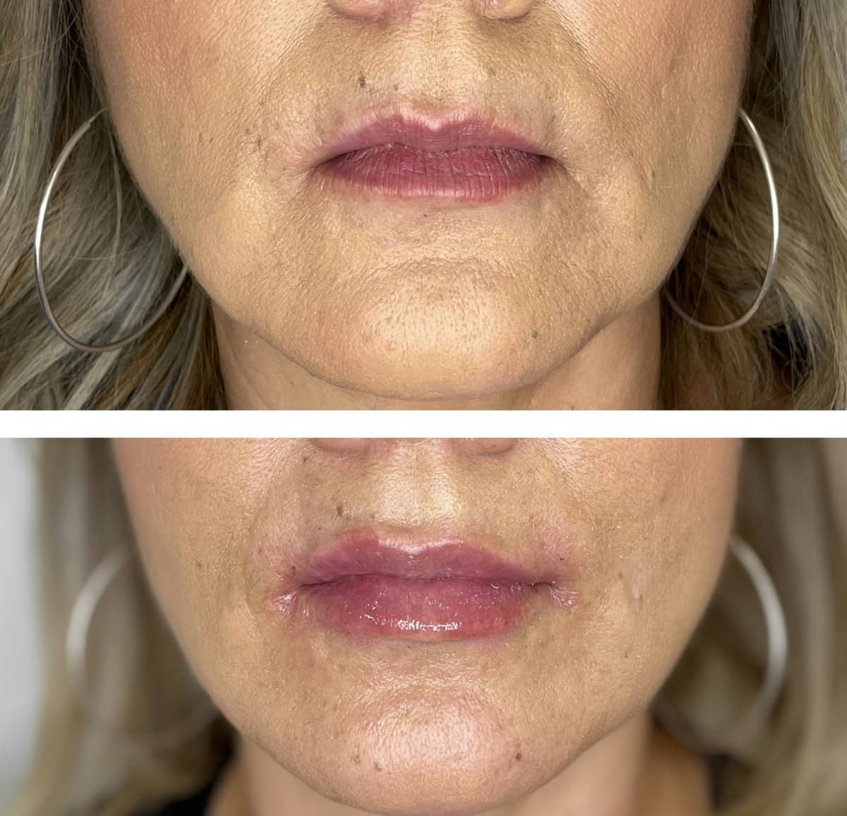Case 16230 - lip lift