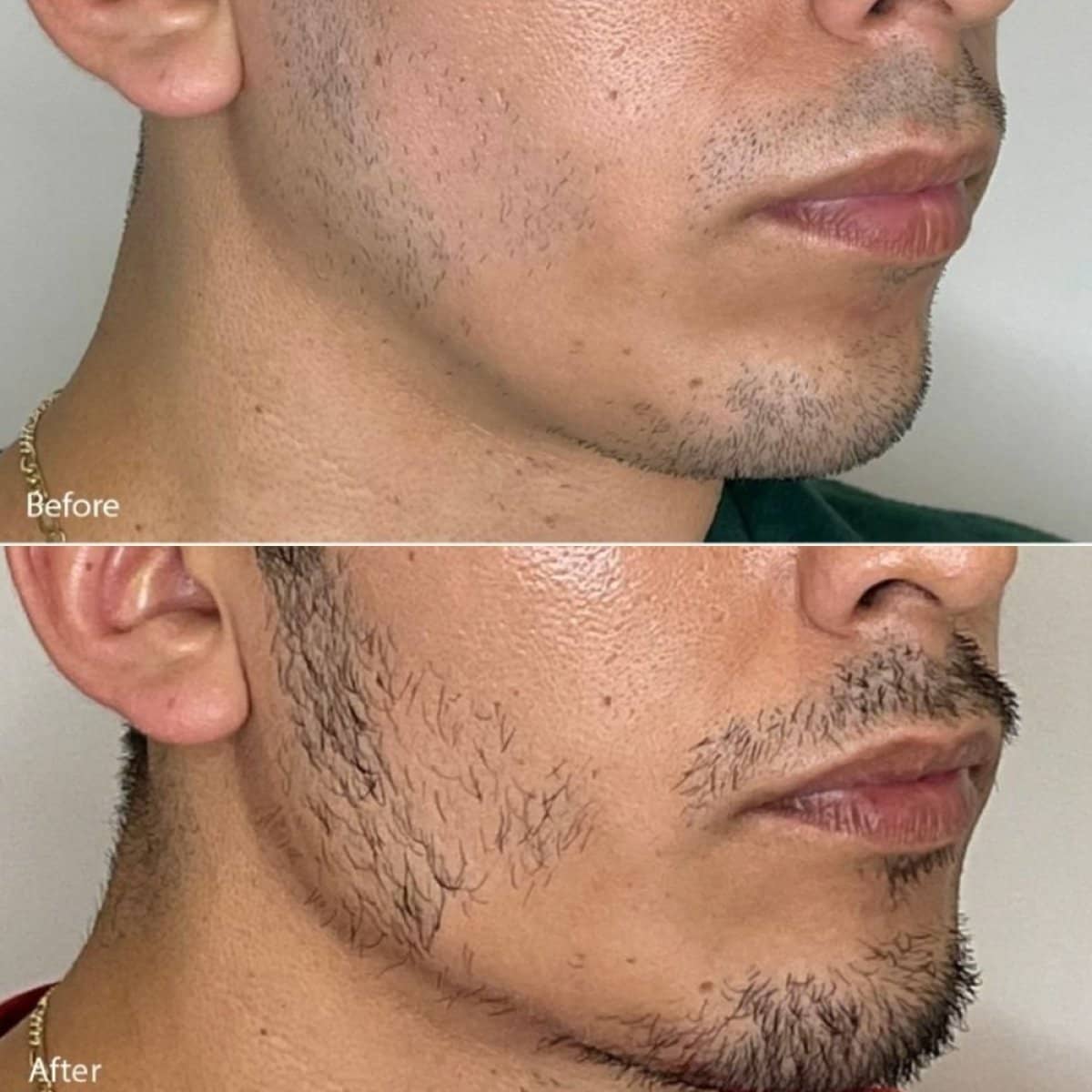 Case 16231 - beard transplant
