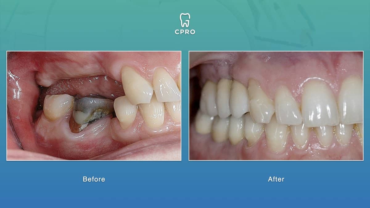 Case 16268 - results of implant-supported dental bridge