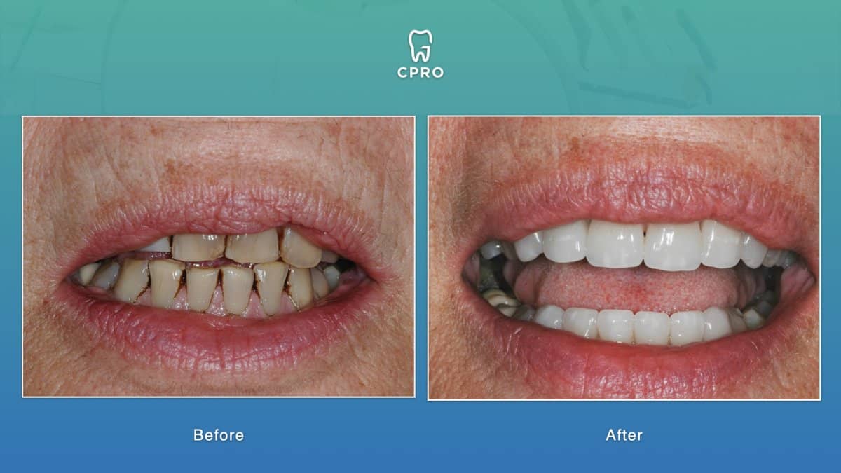 Case 16269 - porcelain crown installation
