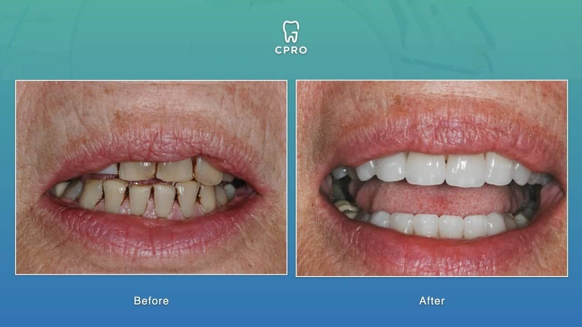Case 16270 - porcelain veneer