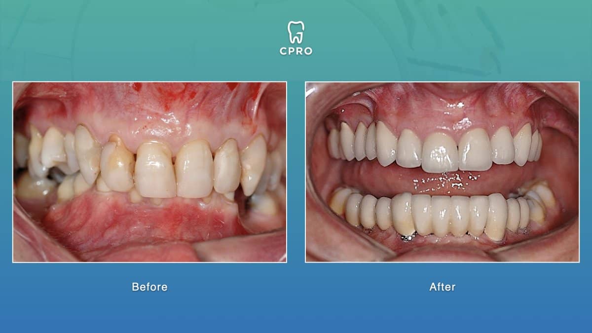Case 16271 - dental crown installation