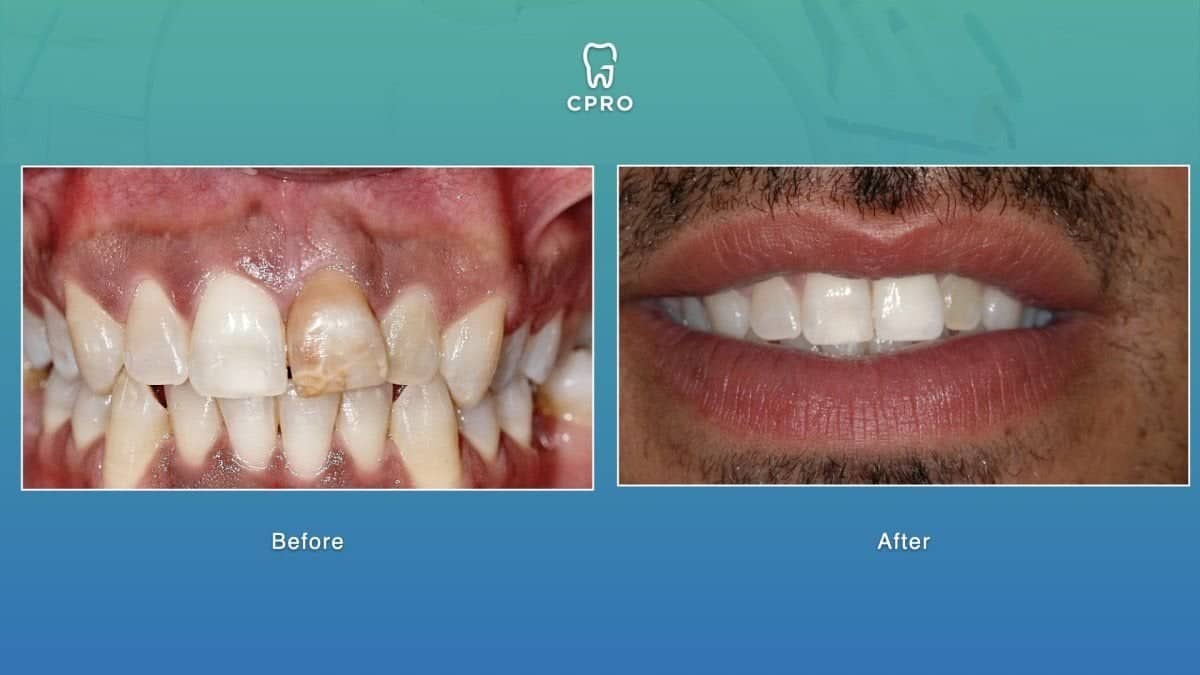 Case 16272 - porcelain veneer