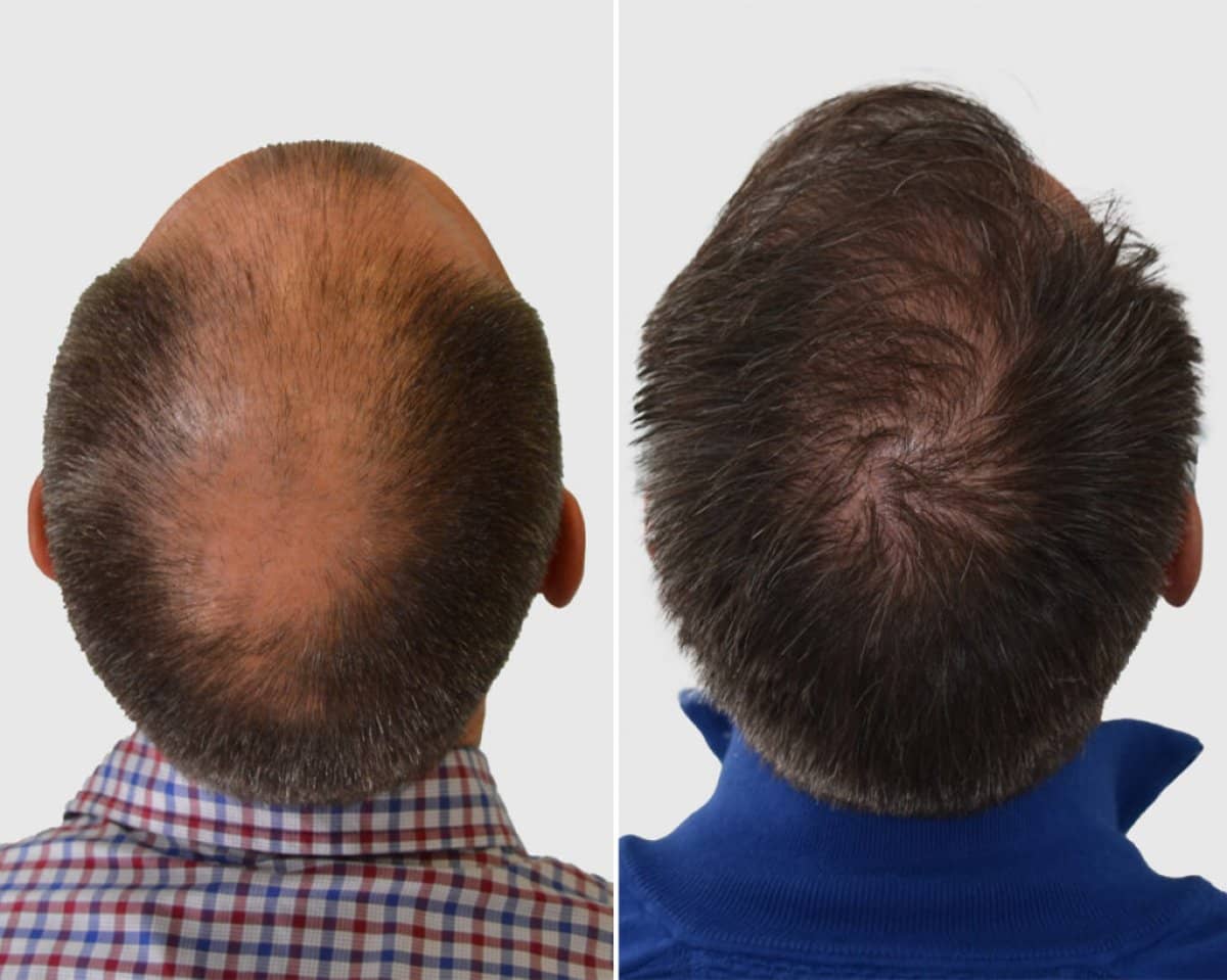 Case 16280 - FUE hair transplant
