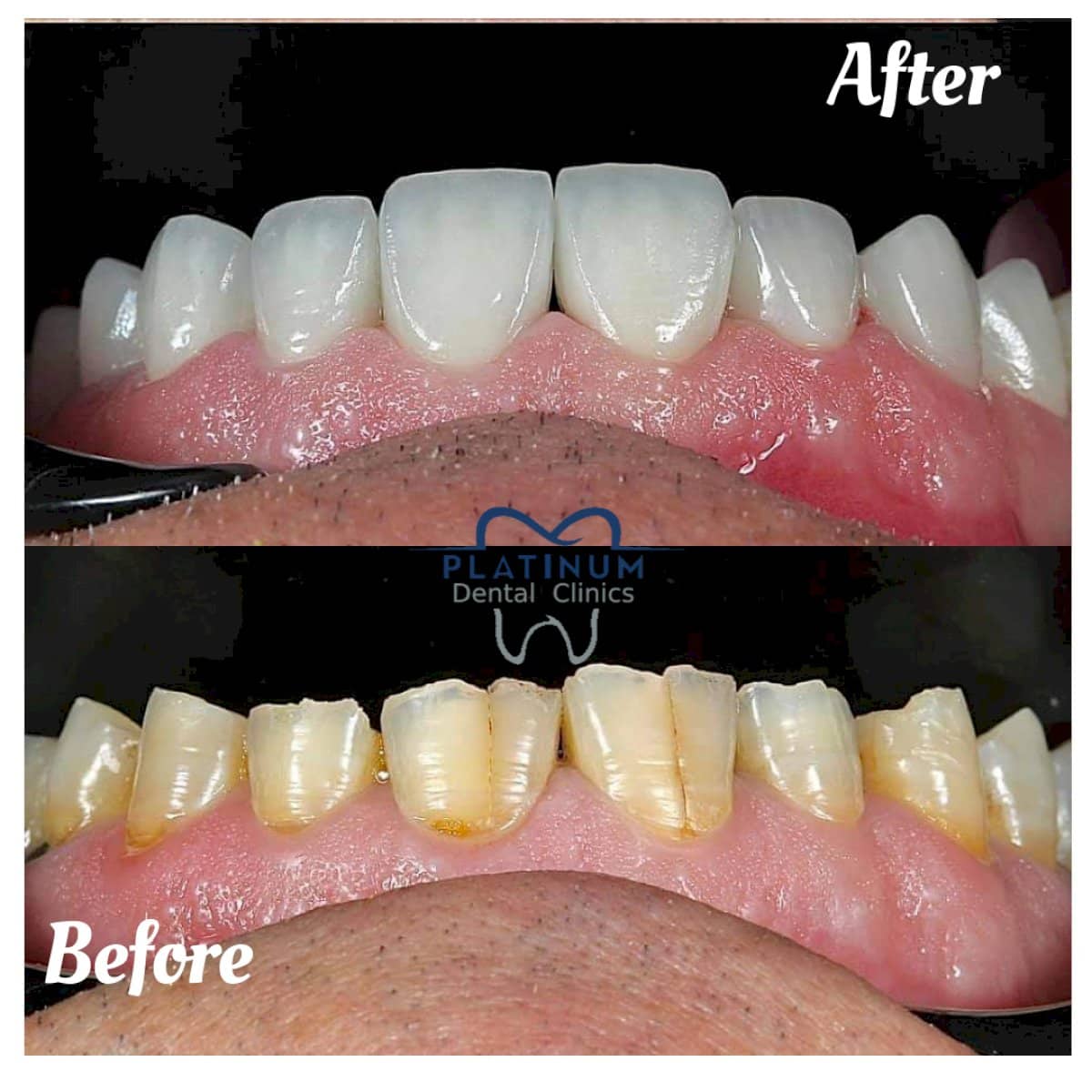Case 16304 - crown lengthening
