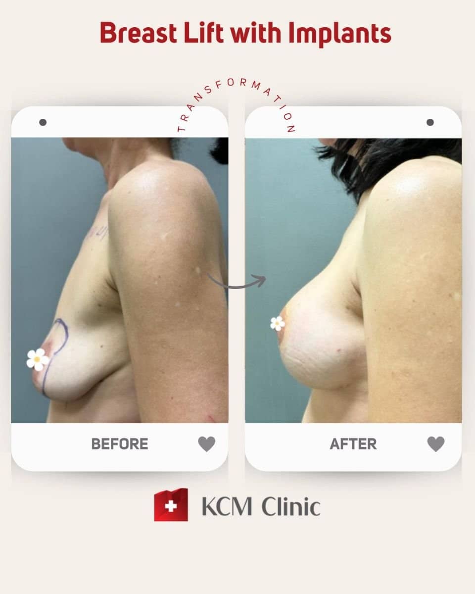 Case 16364 - breast lift with implants