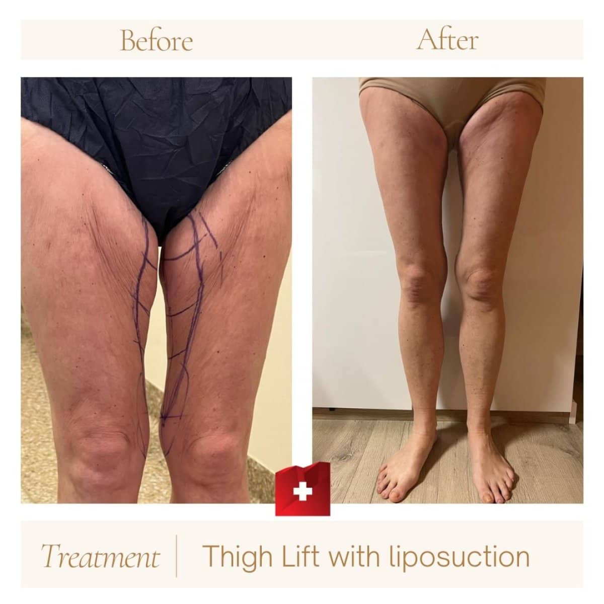 Case 16365 - thigh lift with liposuction