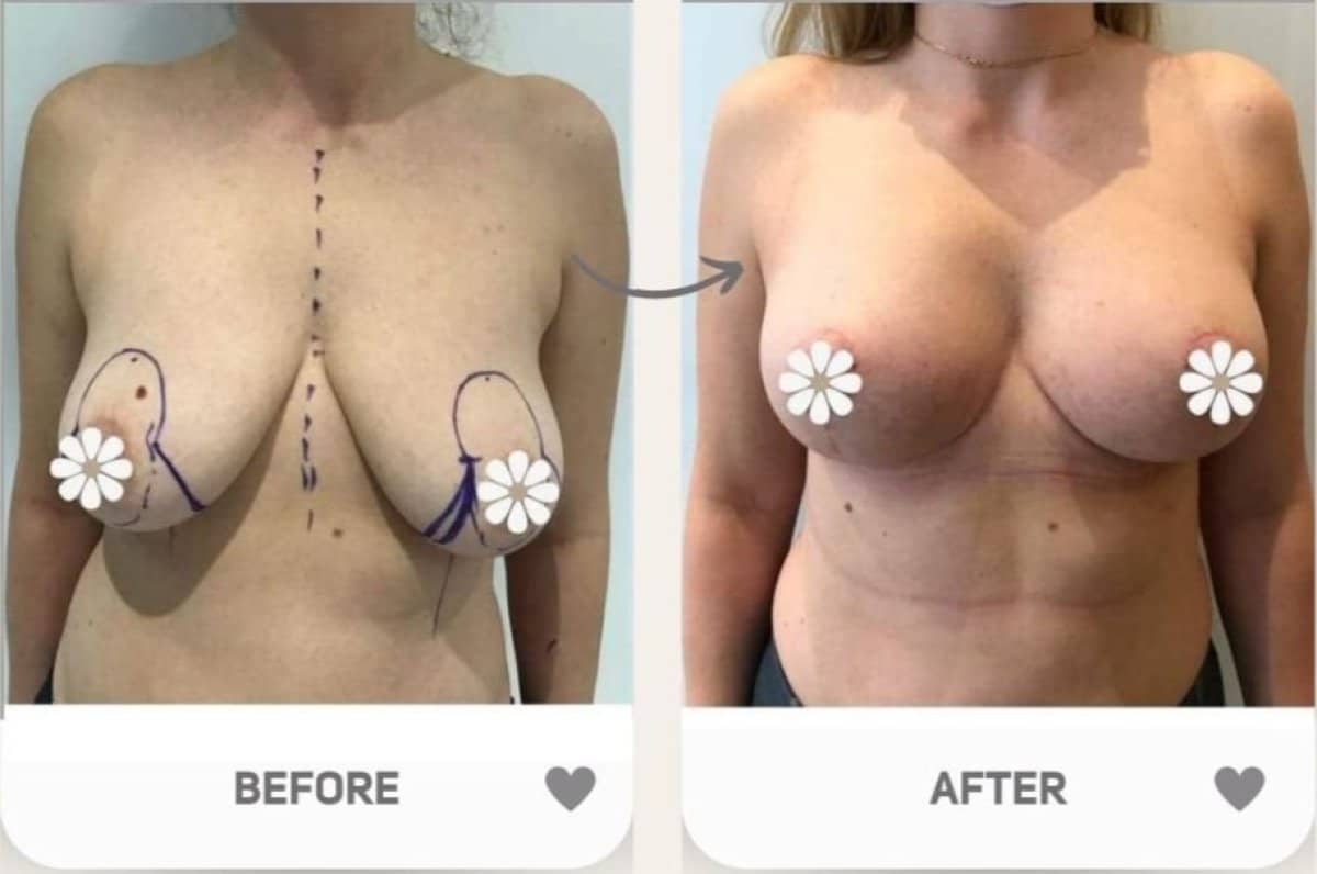 Case 16367 - breast lift