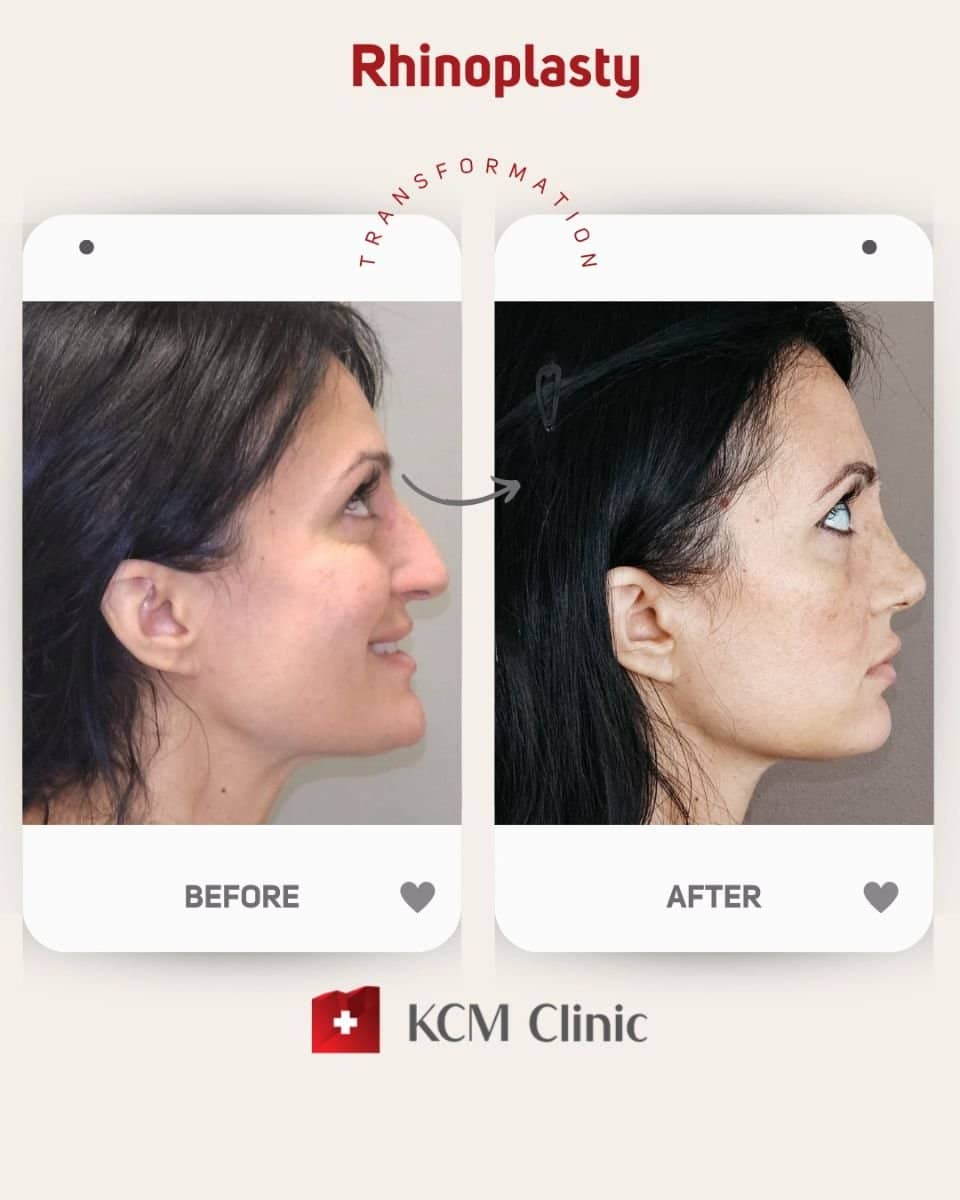 Case 16368 - rhinoplasty
