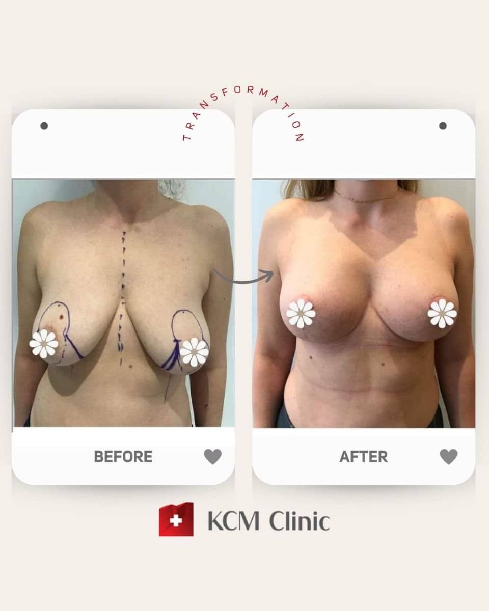 Case 16369 - breast augmentation