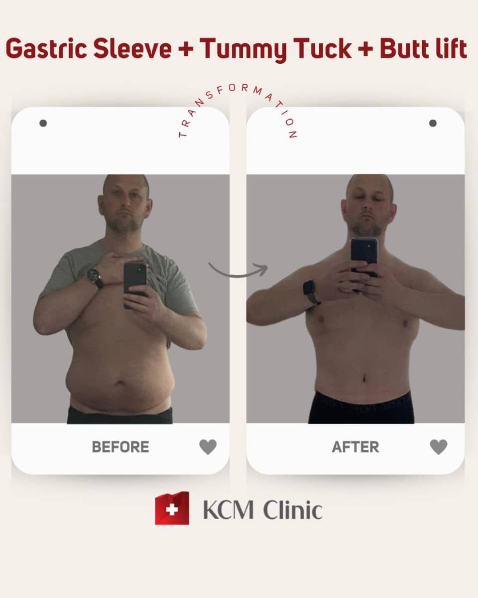 Case 16370 - results of gastric sleeve, tummy tuck, and butt lift