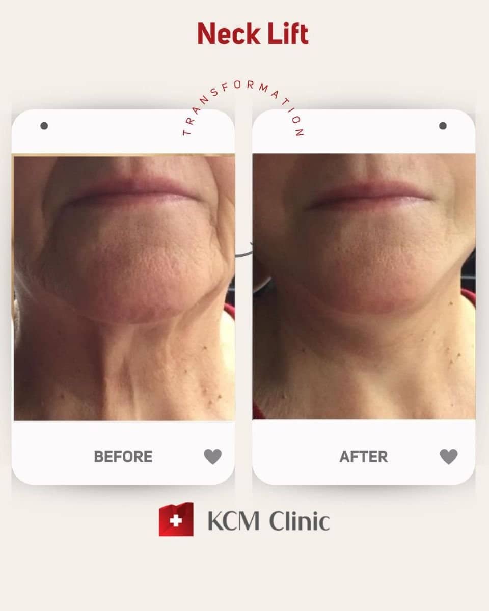 Case 16371 - neck lift