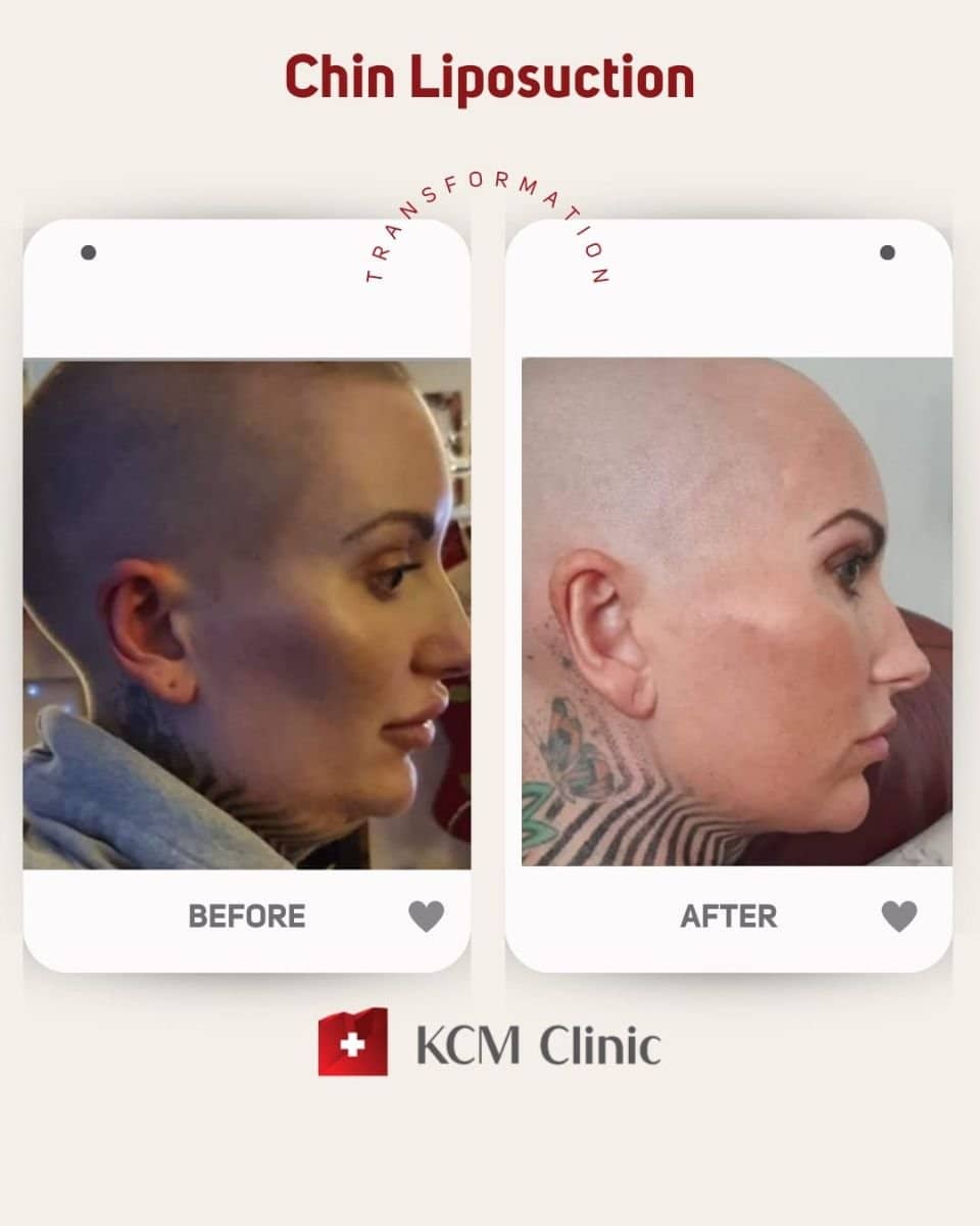 Case 16372 - chin liposuction