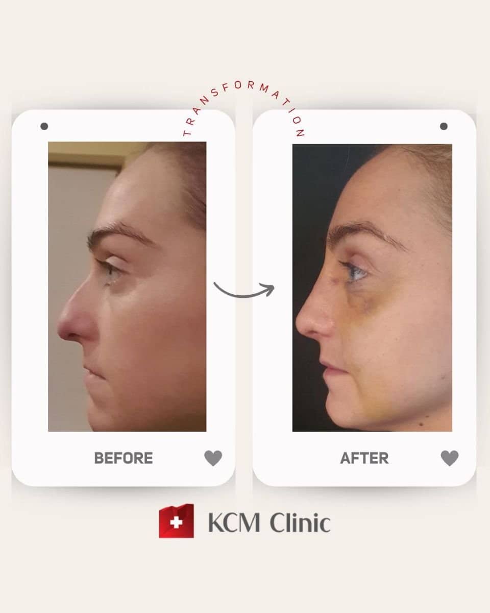 Case 16375 - revision rhinoplasty