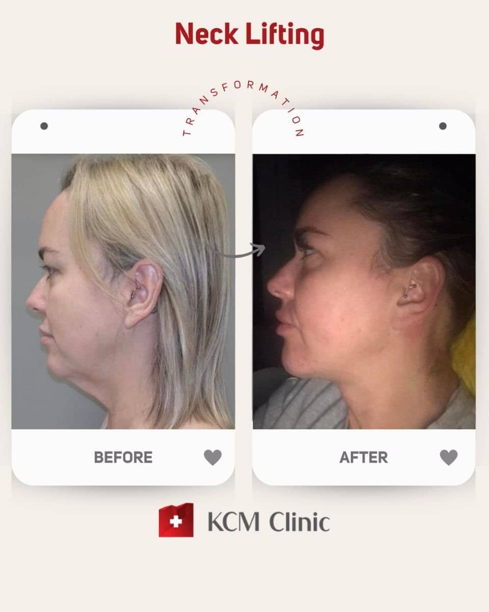 Case 16377 - neck lift