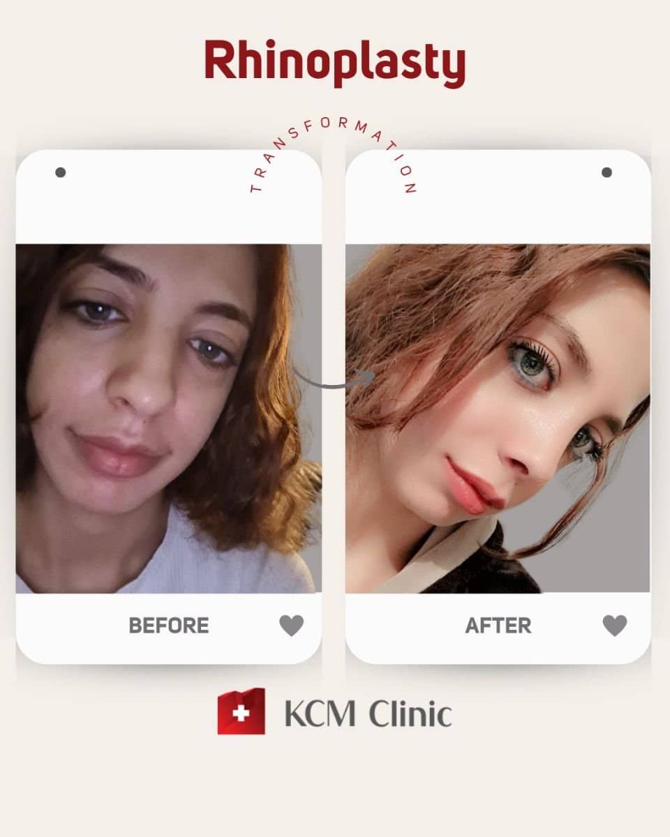 Case 16378 - revision rhinoplasty