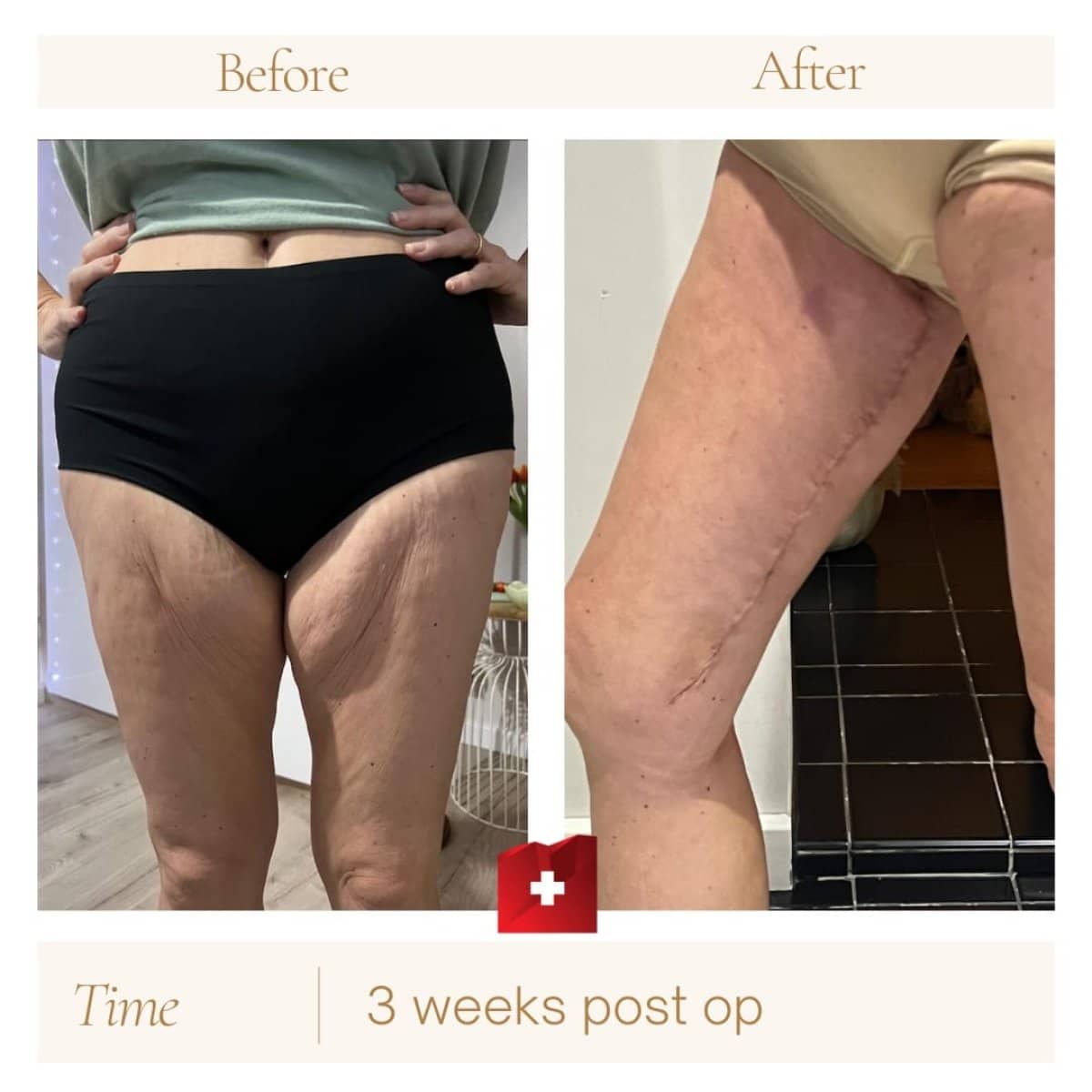 Case 16379 - thigh lift