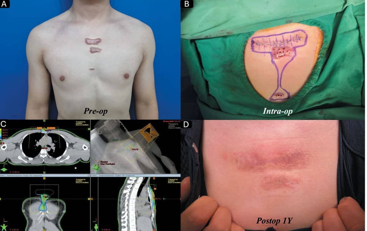 Case 16427 - skin surgery scar revision