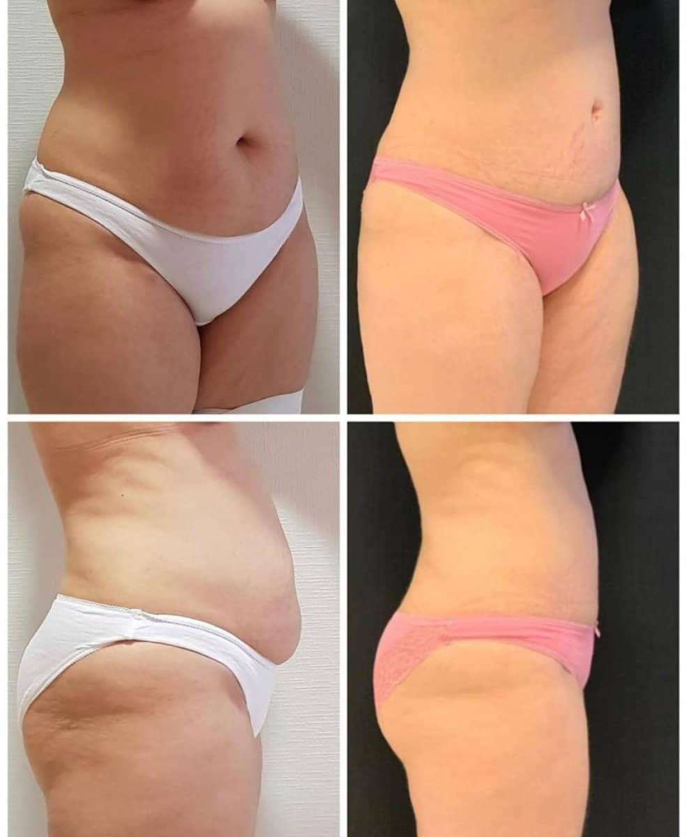 Case 16428 - liposuction