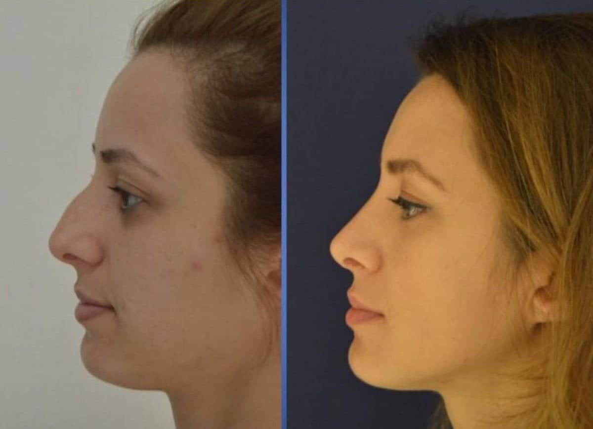 Case 16429 - revision rhinoplasty
