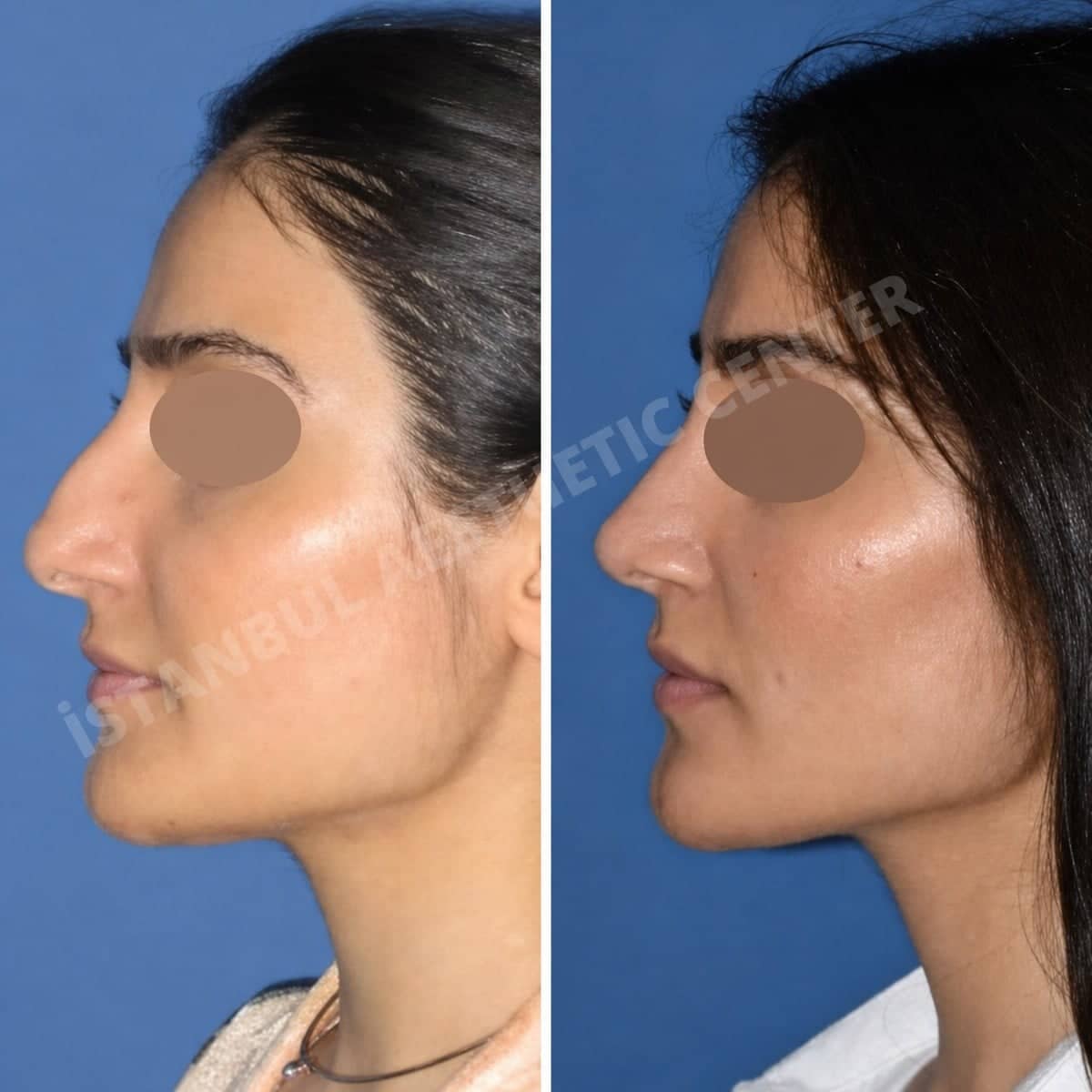 Case 16430 - rhinoplasty