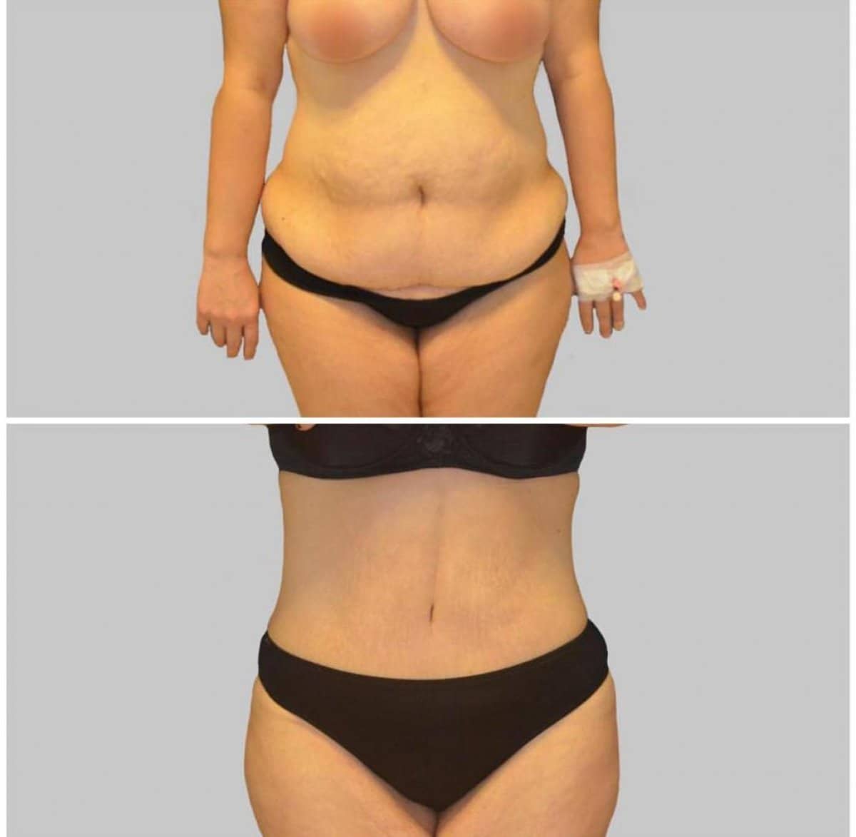 Case 16432 - tummy tuck