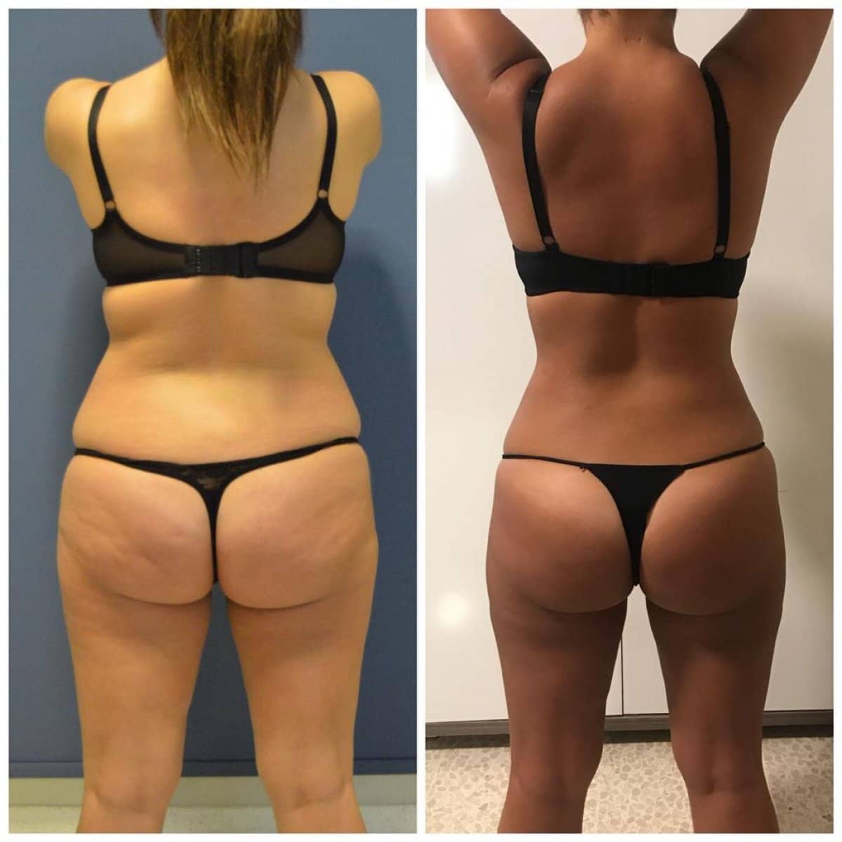 Case 16435 - liposuction