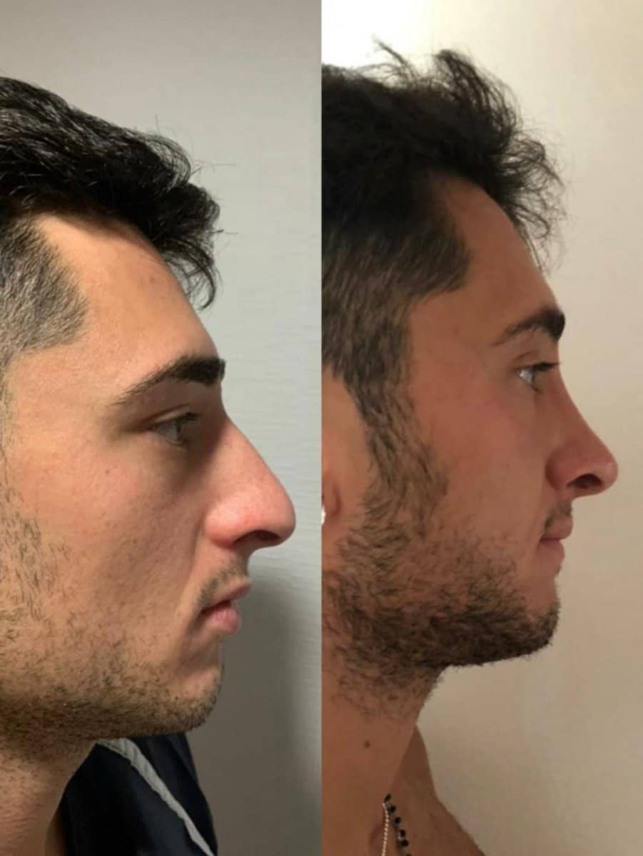 Case 16436 - rhinoplasty