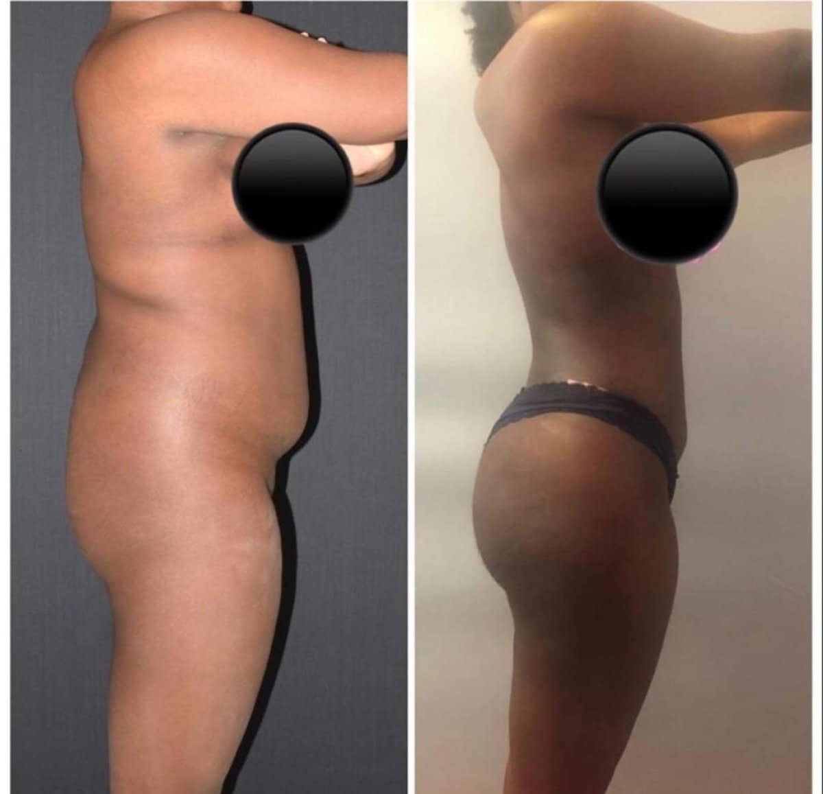 Case 16437 - Brazilian Butt Lift