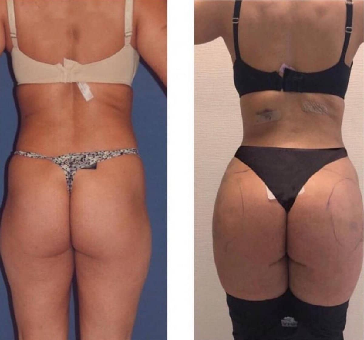 Case 16438 - Brazilian Butt Lift