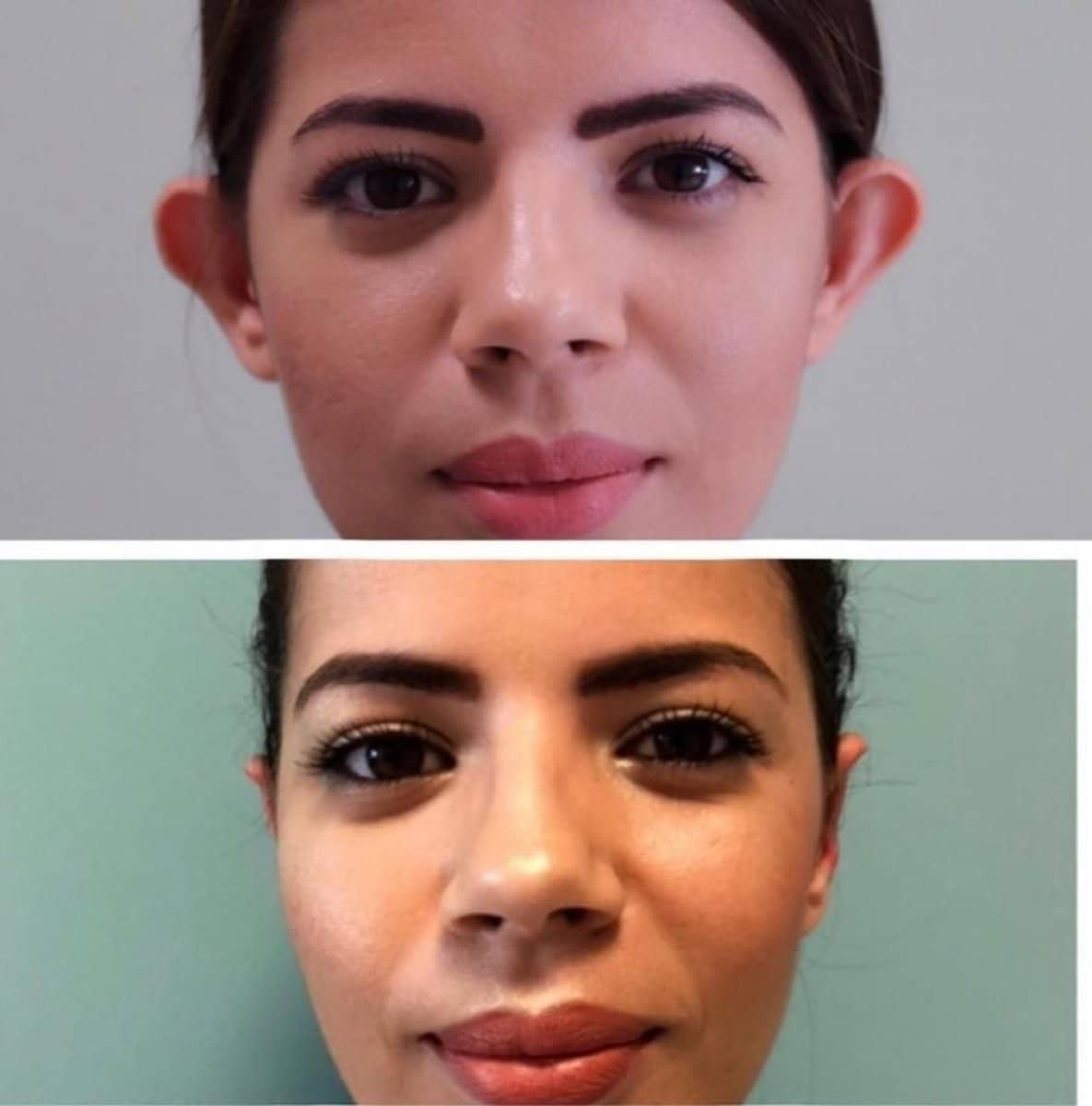 Case 16439 - otoplasty